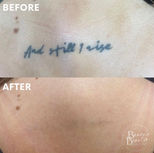 Tattoo removal process