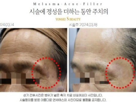 세종점제거? 점빼기? 리터치 안받아도 된다고요?