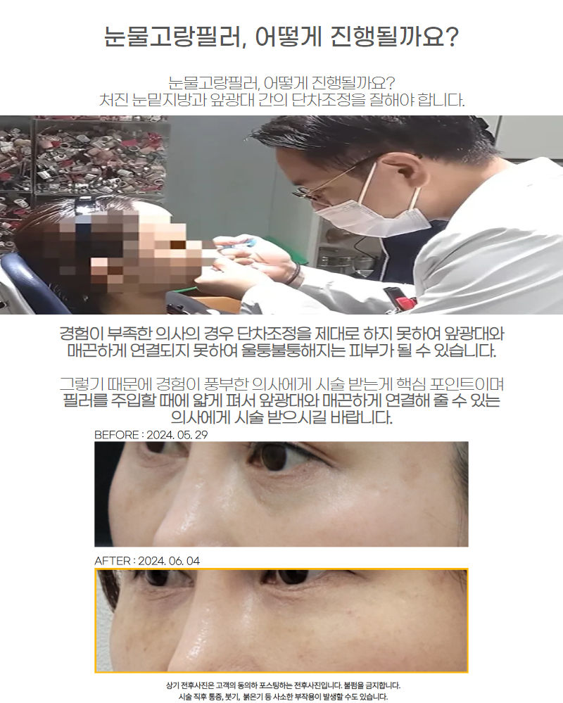 ฟิลเลอร์ร่องฉีก 4.jpg