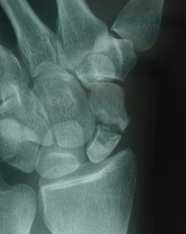 Scaphoid non-union