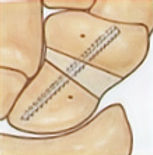Scaphoid open reduction and bone graft