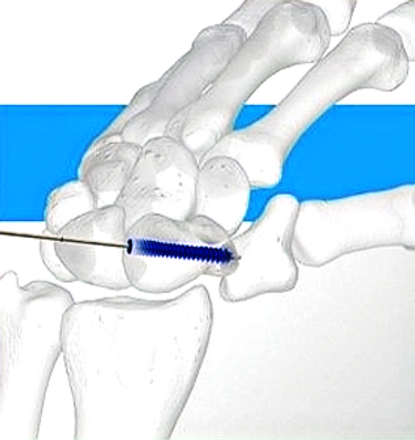 Scaphoid screw fixation