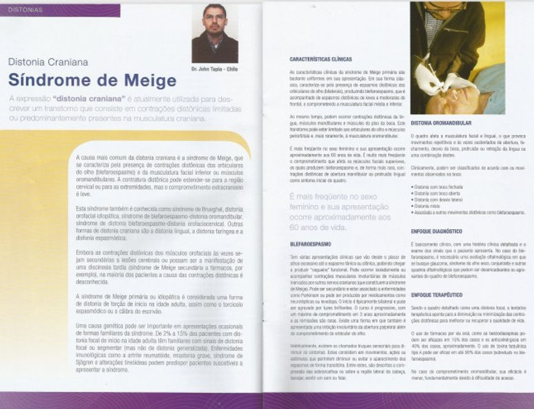 Distonia-Craniana-Si3ndrome-de-Meige-680