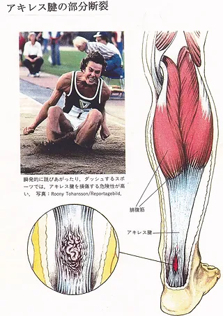 アキレス腱の痛み 坂東接骨院 交通事故治療やムチウチ オスグッド へバーデン 足底筋膜炎 四十肩 腱鞘炎 首の痛みに必要な施術でお楽に アキレス腱の痛み 坂東接骨院 交通事故治療やムチウチ オスグッド へバーデン 足底筋膜炎 四十肩 腱鞘炎 首の痛みに必要な施術でお楽に
