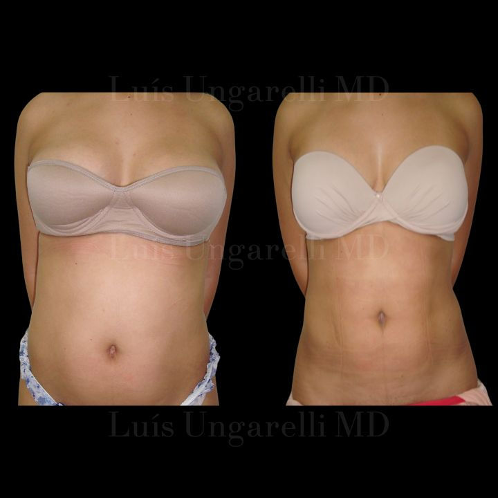 Lipofracionada abdome