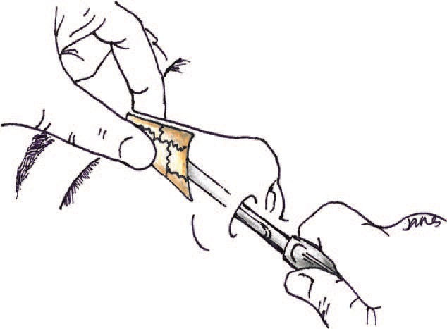 The Boies elevator inserted under the nasal bone