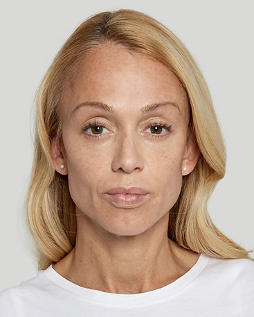 Woman with shallower reduced wrinkles after injected fillers