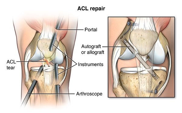 aclreconstruction2.jpeg