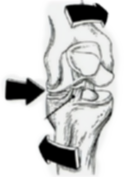 acl-tear_valgus1_edited_edited_edited.pn