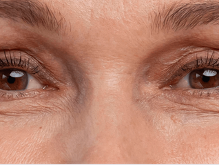 How to Get Rid of Under-Eye Wrinkles: A Treatment Guide for Malaysian Skin
