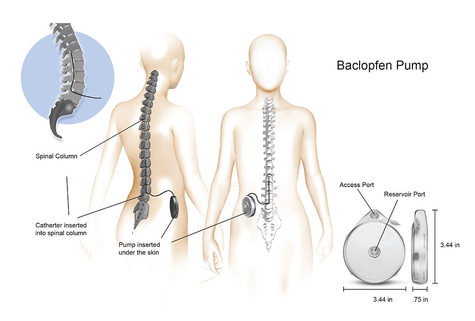 Color Illustrations Baclopfen Pump-001 1.jpg