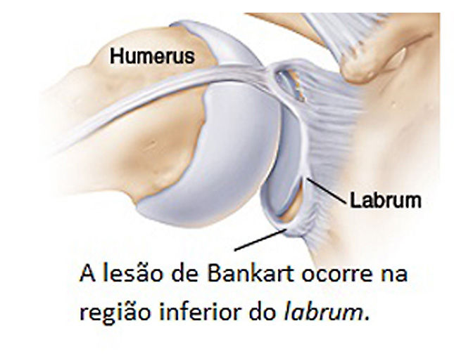 Luxação de ombro Luxação de ombro
