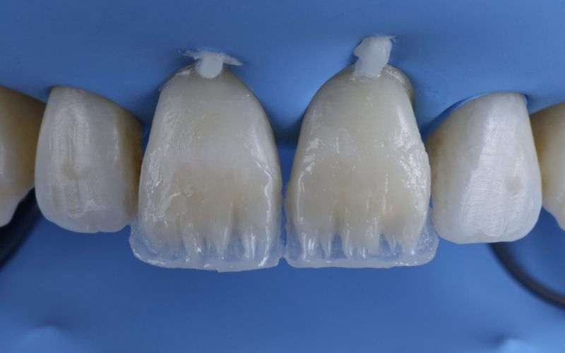 estratificacao-de-resinas-compostas-em-dentes-anteriores.jpg