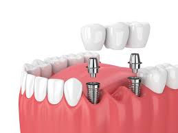 Questions: How Long Do Dental Implants Last?