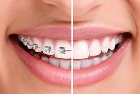 How to Straighten Teeth Without Braces: Effective Alternatives for a Confident Smile