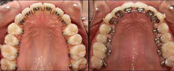 Lingual Braces: Pros and Cons for the Informed Orthodontic Professional