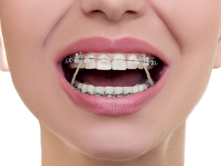 Understanding Braces Rubber Bands: The Essential Guide