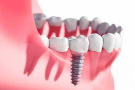 The Complete Guide to the Dental Implant Procedure
