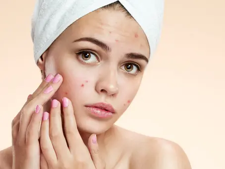 MỤN TUỔI DẬY THÌ: NGUYÊN NHÂN VÀ CÁCH ĐIỀU TRỊ VỚI ACNE GEL CỦA ACNECIN