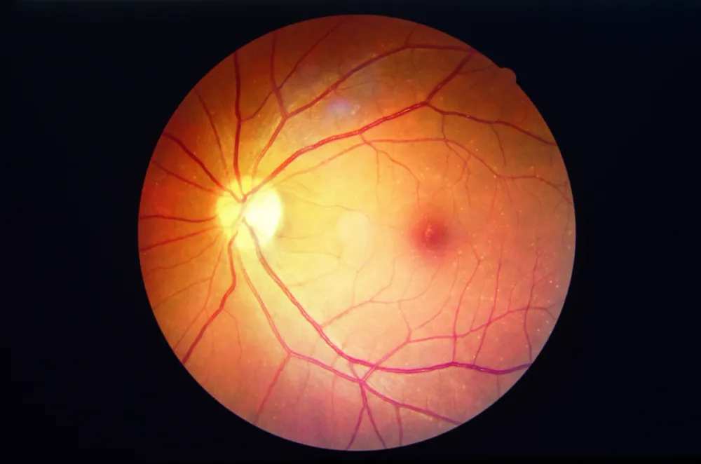 Retina2.webp
