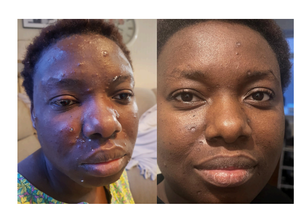 Before and after images of the face of a young lady with Chickenpox showcasing a personal skincare journey, highlighting noticeable improvements in skin texture and clarity, four days after using Nature Faithfuls Natural skincare products.