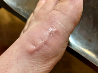 My Recovery: A Ballet Dancer's Journey Recovering from Foot Surgery