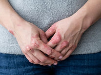 psoriase.jpg