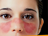lupus-eritematoso-sistemico.jpg