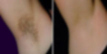 Diolaze - Before After-1.jpeg