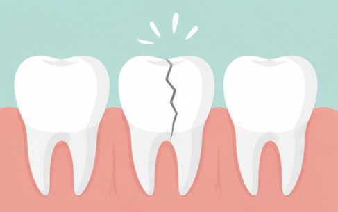 Cracked or Broken Tooth