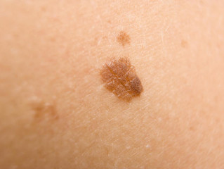 Fibroma, Frequently Asked Questions