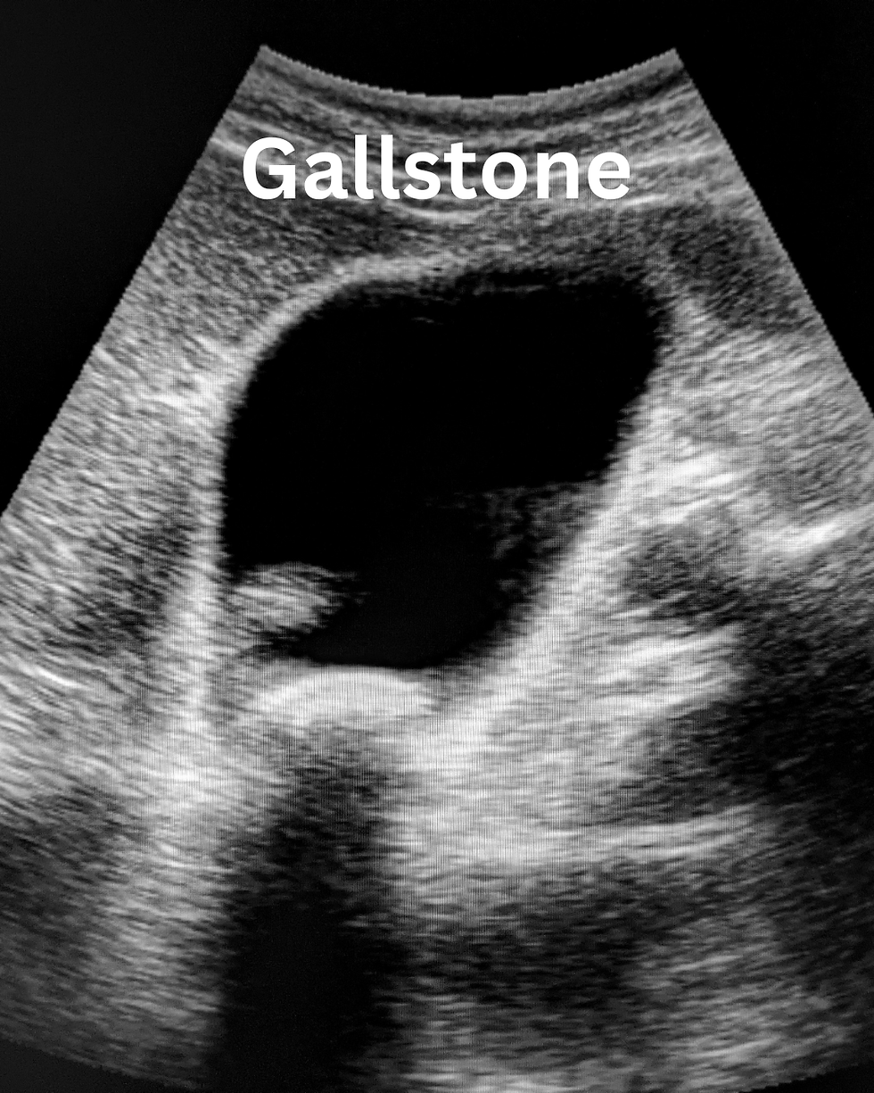 Ultrasound of gallbladder and Gallstone