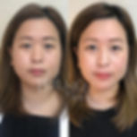 pcl埋線隆鼻香港醫生效果.jpg