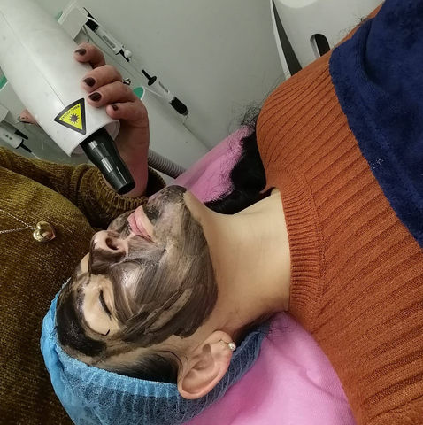 קרבון לייזר טיפול פנים חנה שלו גולד קומסטיקס