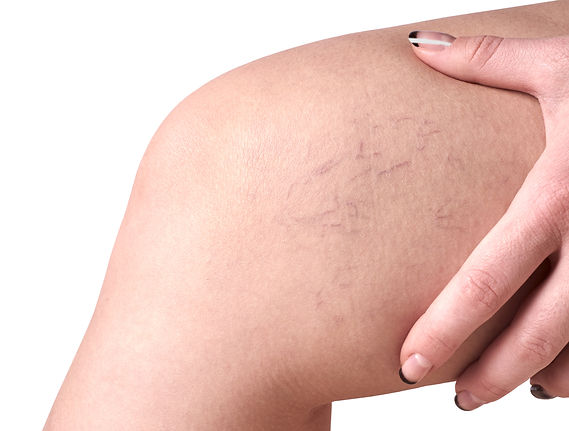 Picture of leg veins