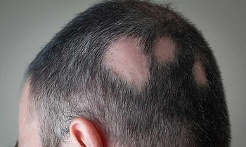 A man with patches of hair loss of alopecia areata.