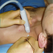 INTERSCALENE BRACHIAL PLEXUS BLOCK FOR SHOULDER SURGERY