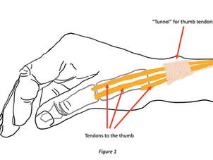 DE QUERVAIN’S SYNDROME