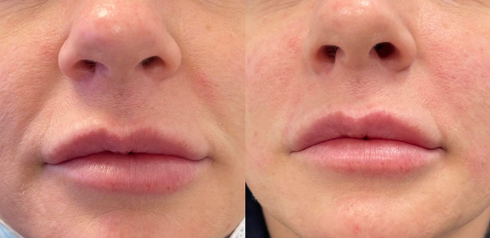 Before and after comparison of dermal filler treatment showcasing enhanced lip volume and smoother skin texture.