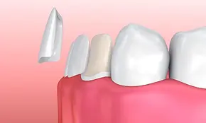 Veneers.webp