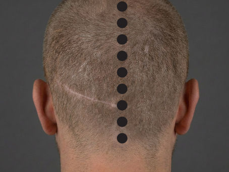 Can Scalp Micropigmentation Hide Hair Transplant Scars? A Practical Guide from Our London Studio
