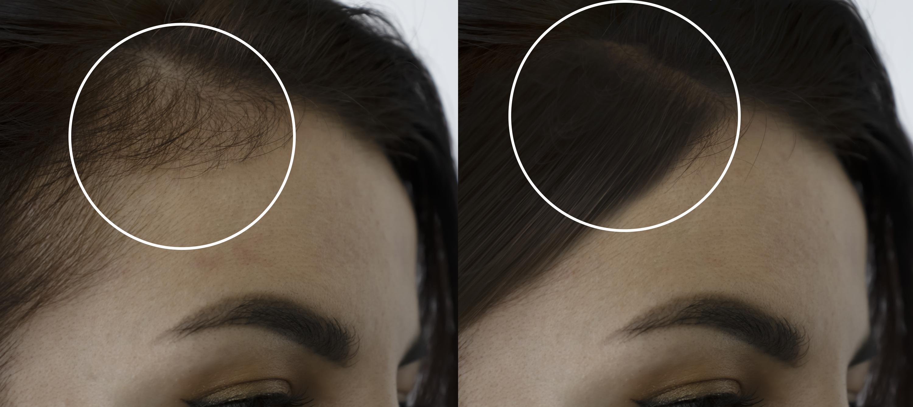 Scalp micropigmentation for thinning hair: what it can do and how we plan your treatment