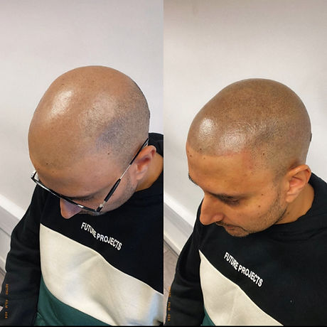 Choosing Your SMP Style: Subtle Finish, Fuller Appearance or the Clean‑Shaved Look