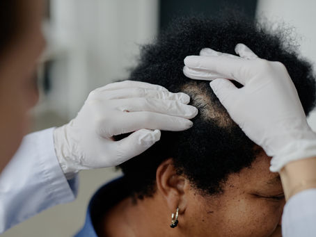 Scalp Micropigmentation in Walthamstow: Discreet, Immediate Results for Thinning Hair and Scars