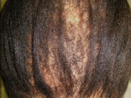The Science Behind Scalp Micropigmentation: How We Replicate Natural Hair Follicles