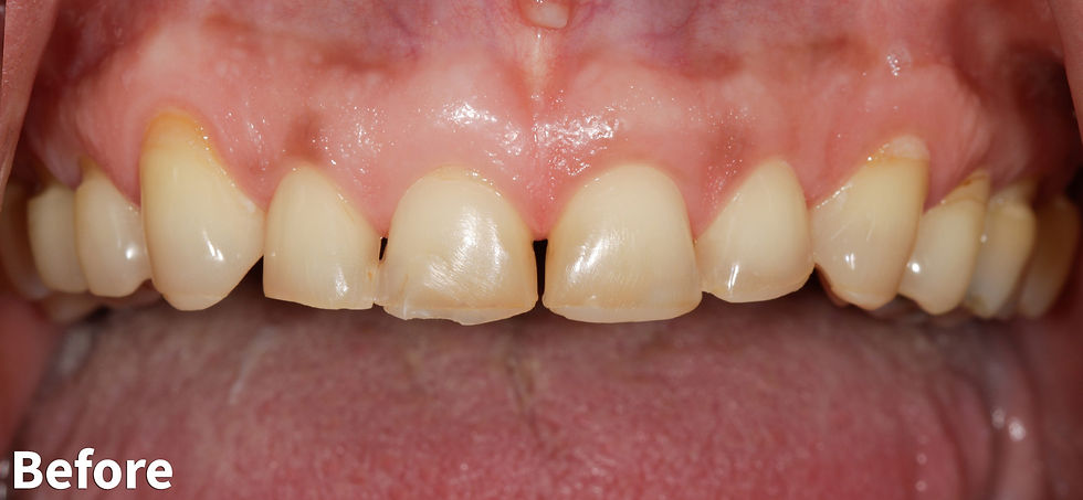 Upper Row of Teeth Before Treatment
