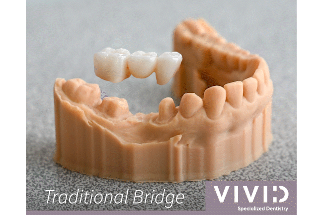 Traditional Bridge on and off model at Vivid Specialized Dentistry 5.gif