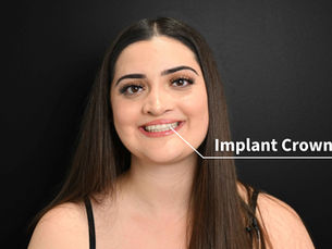 Patient smiling with an arrow pointing to her new implant crown replacing a missing adult tooth, showing natural-looking results from Vivid Specialized Dentistry in Edmonton.