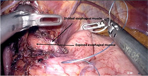 Computer Vision–Based Identification of Esophageal Mucosa in Heller Myotomy Videos