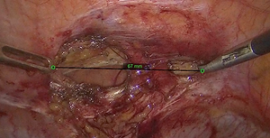 Computer Vision–Based 3D Measurement and Spatial Quantification from Laparoscopic Videos